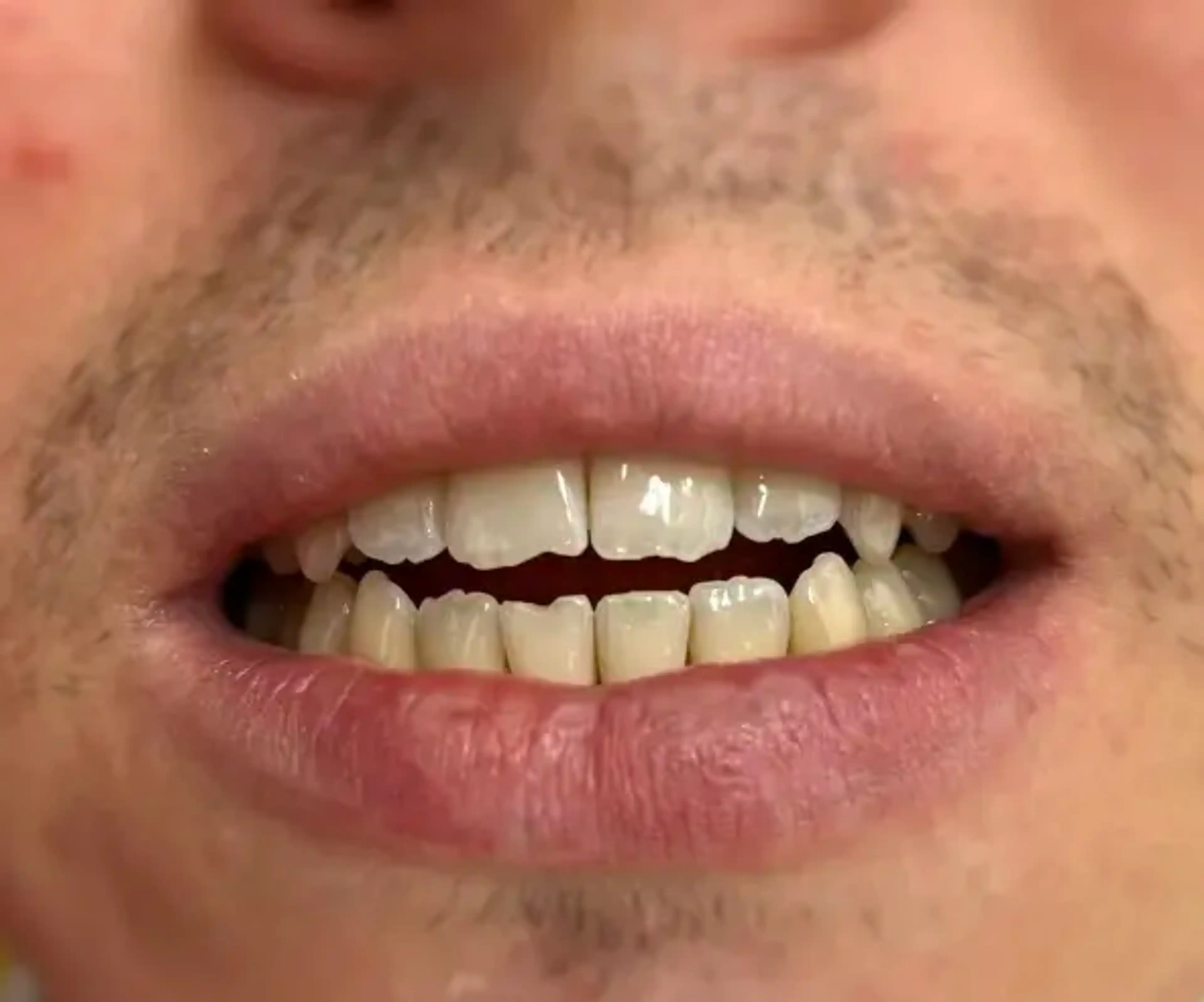 Înainte de tratament