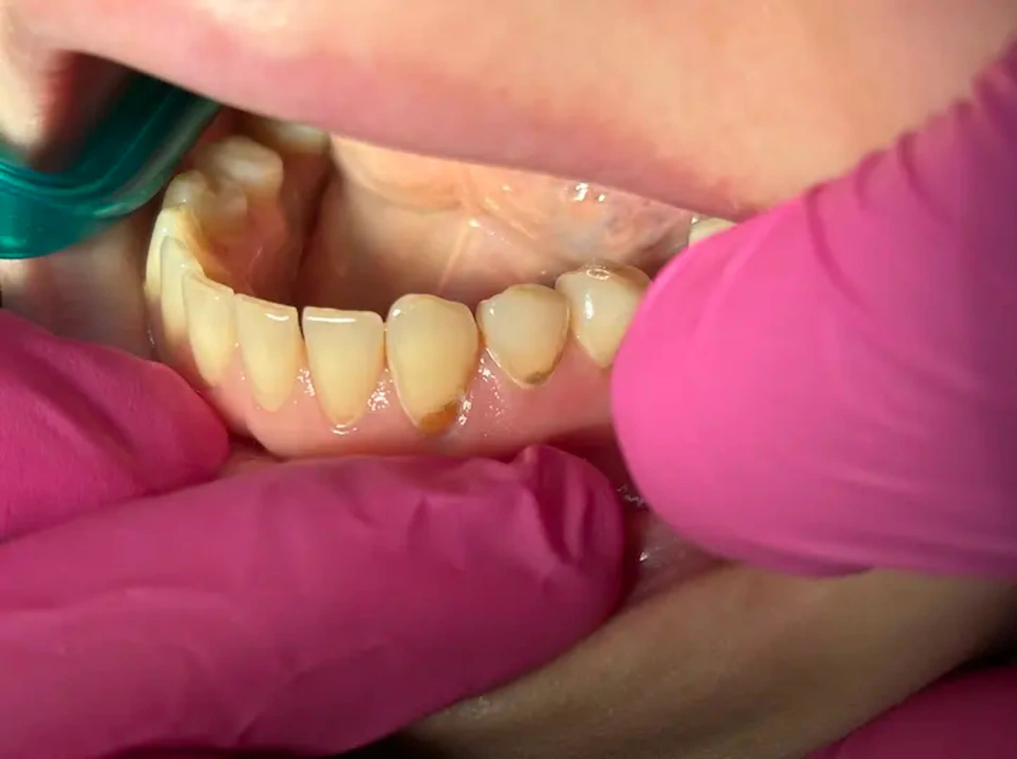 Înainte de tratament