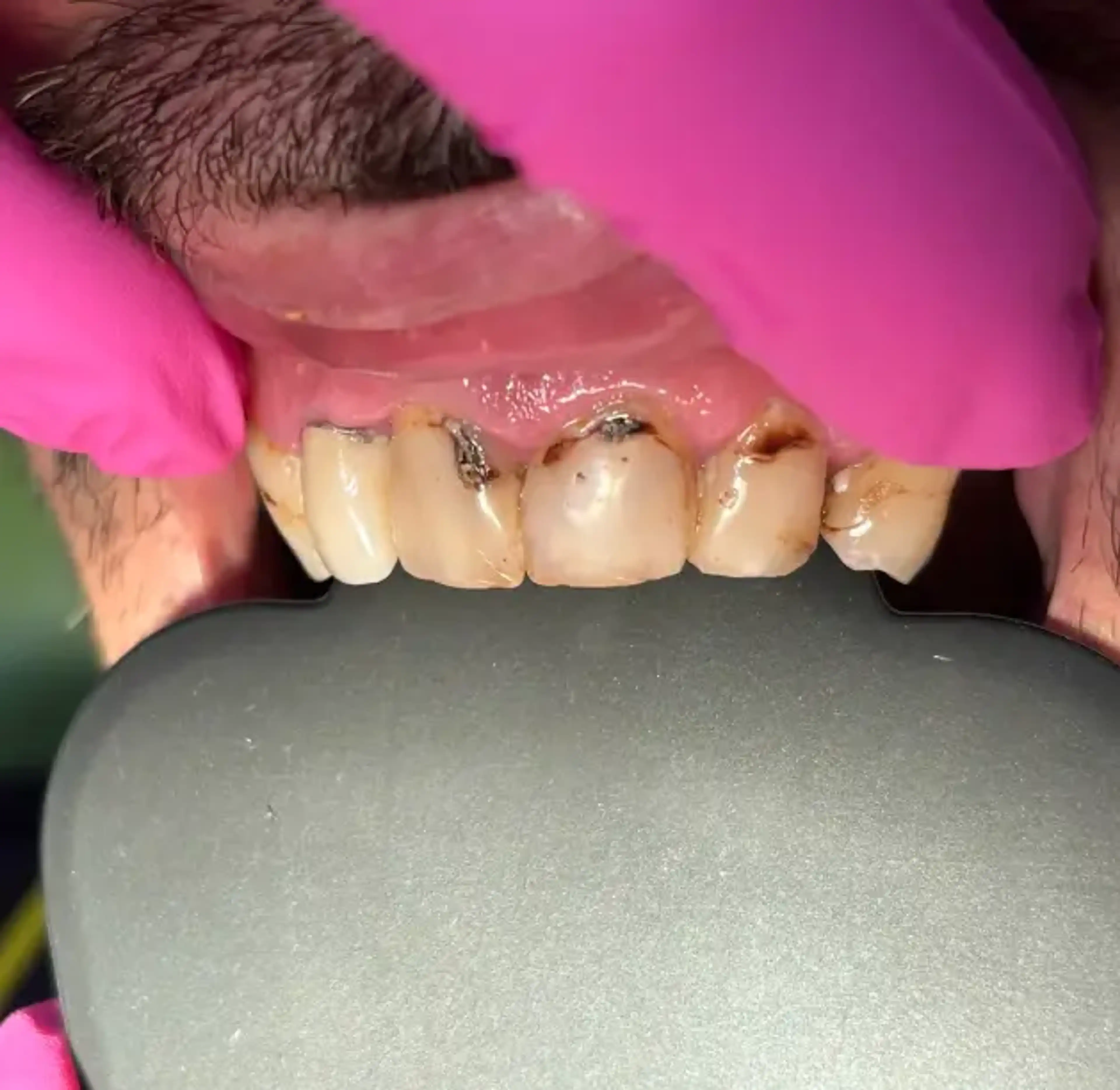 Înainte de tratament