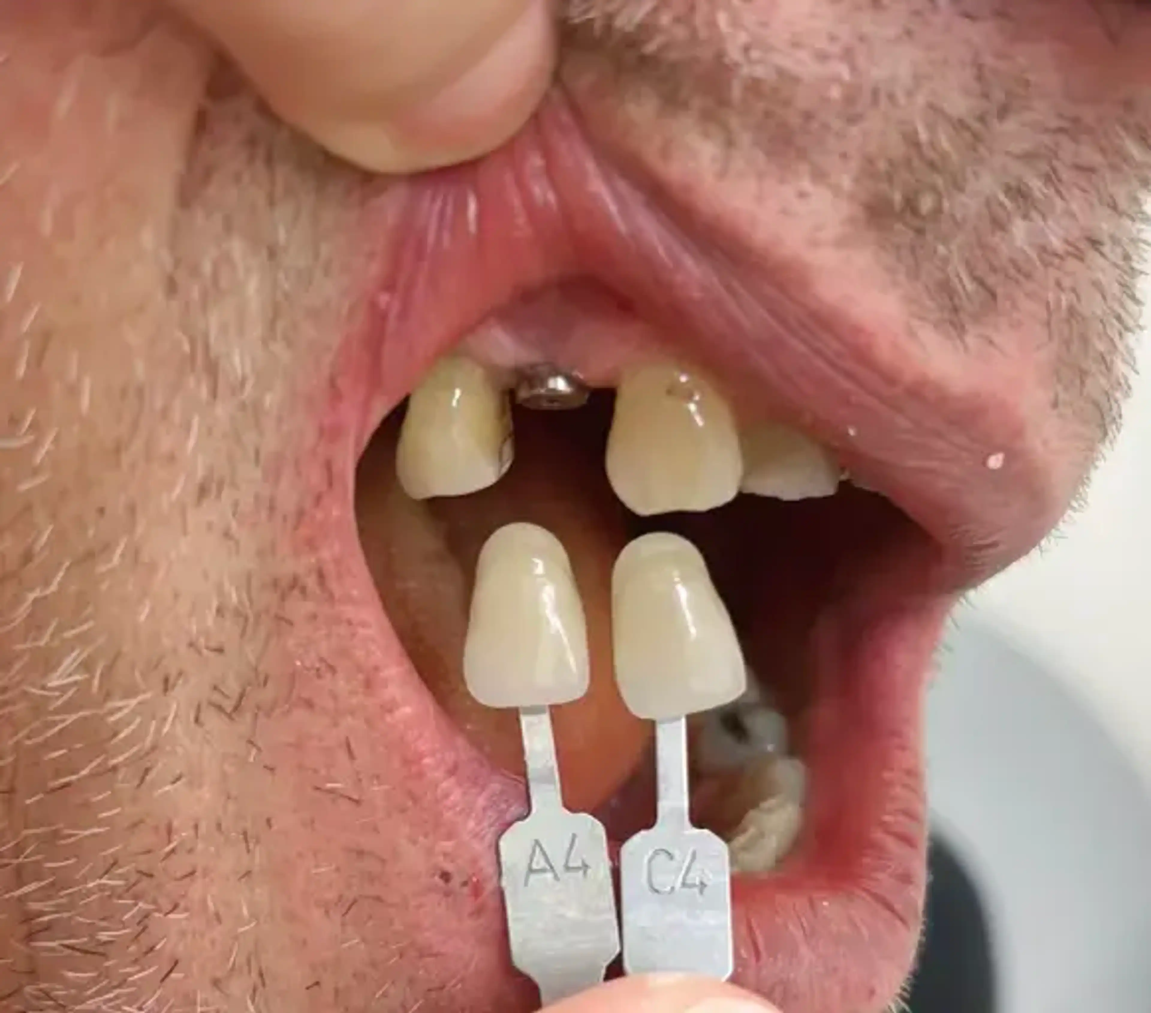 Înainte de tratament